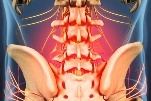 oorzaken en symptomen van osteochondrose