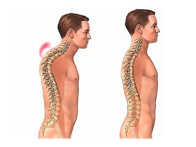 Spinale kyfose