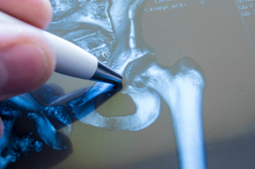 Artrose van het heupgewricht op de röntgenfoto