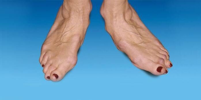 misvorming van de voet met enkelartrose