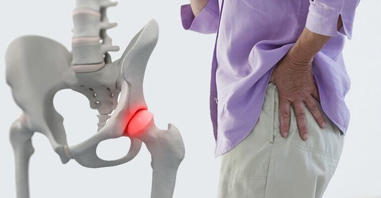 pijn in het heupgebied - een symptoom van artrose van het heupgewricht