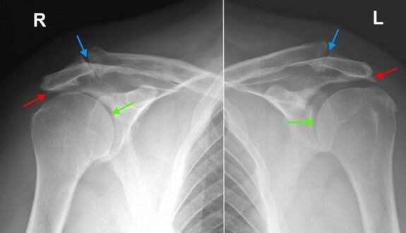 Röntgenfoto van de schoudergewrichten