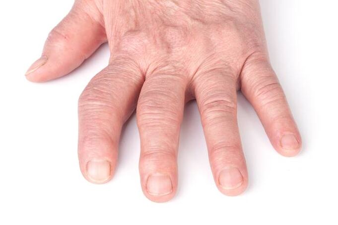 vervormende artrose op de handen