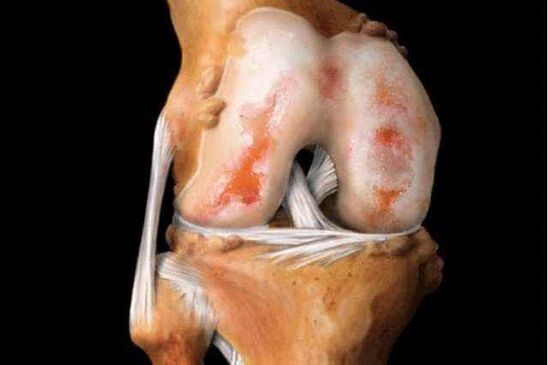 schade aan het kniegewricht met artrose