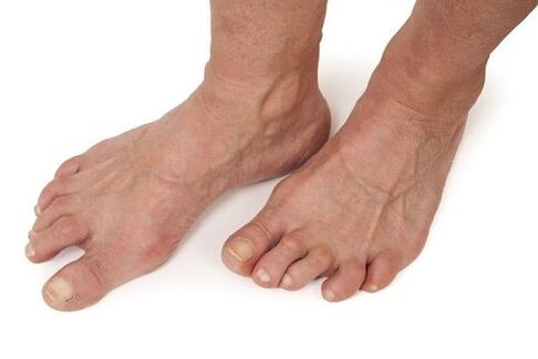 voeten aangetast door artrose
