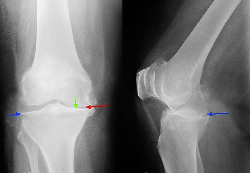 röntgenfoto van artrose van het kniegewricht