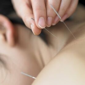 Acupunctuur