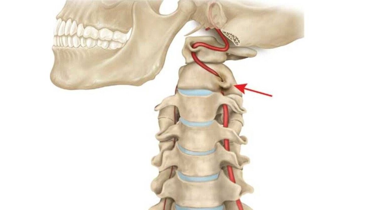 osteochondrose van de cervicale wervelkolom